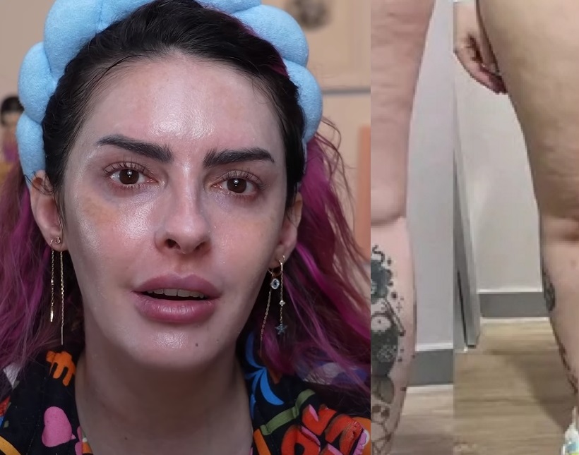 Karen Bachini revela diagnóstico de doença crônica lipedema: ‘pernas sempre inchadas'