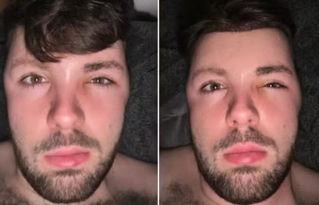 Jovem ignora restrições médicas de não fazer sexo e sofre reação após transplante capilar