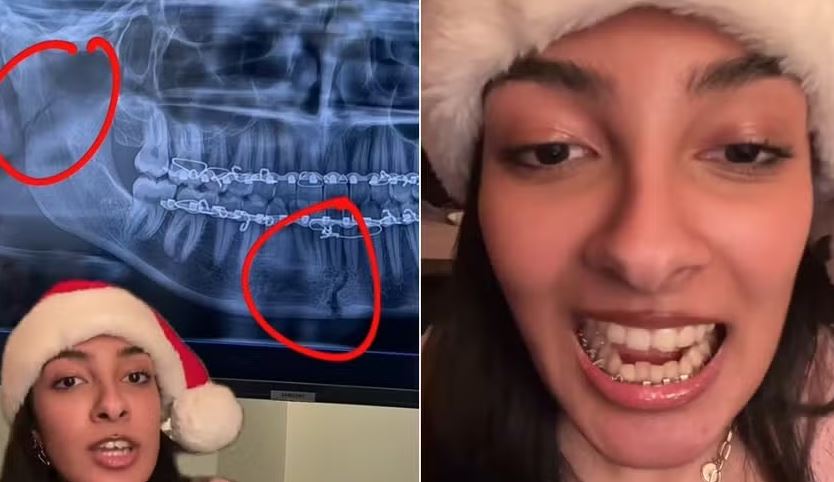 Jovem sofre fratura dupla no maxilar ao mastigar doce