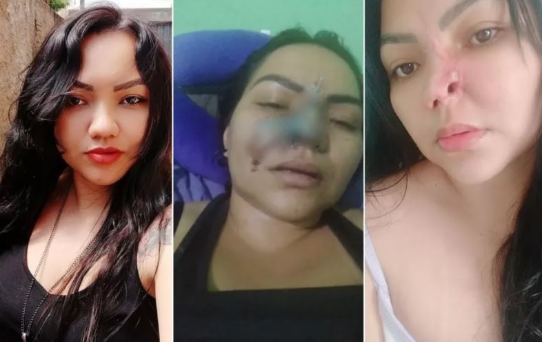 Mulher perde parte do nariz após passar por procedimento estético com dentista