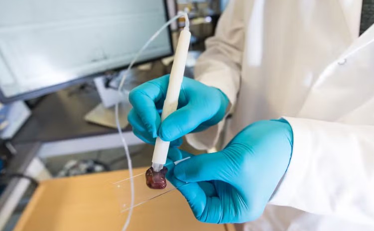 Brasileira desenvolve caneta que detecta câncer em apenas 10 segundos 