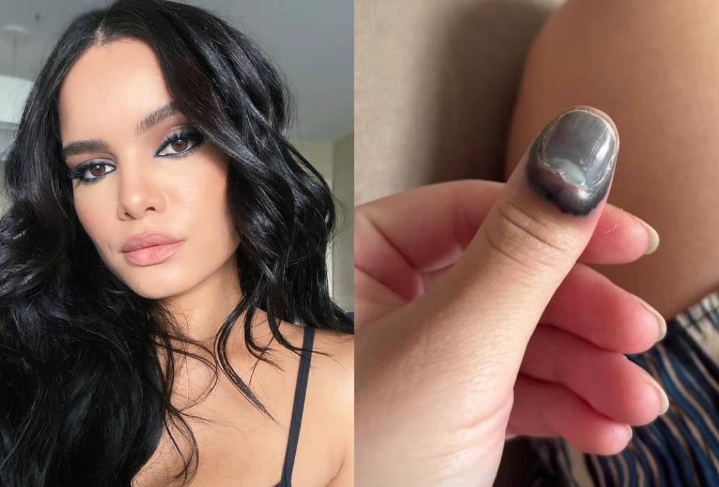 Carol Macedo passa por cirurgia após prender dedo na porta do carro 