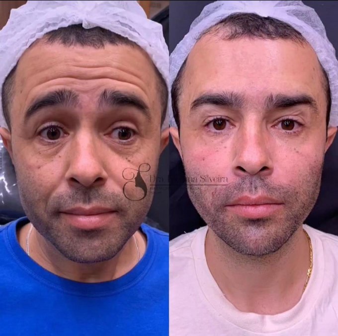 Motorista que atropelou Kayky Brito faz harmonização facial e mostra resultado