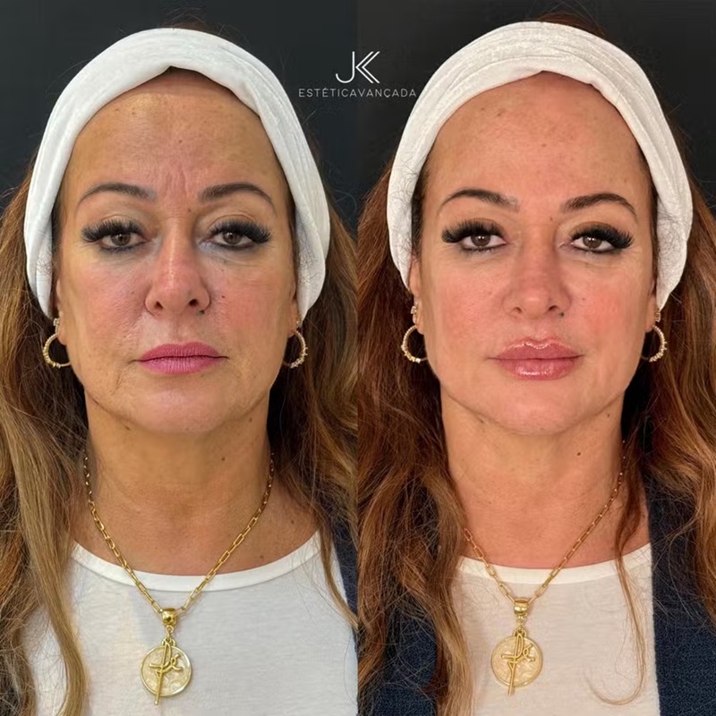  Mãe de Neymar faz rejuvenescimento facial com rinomodelação e mais; fotos