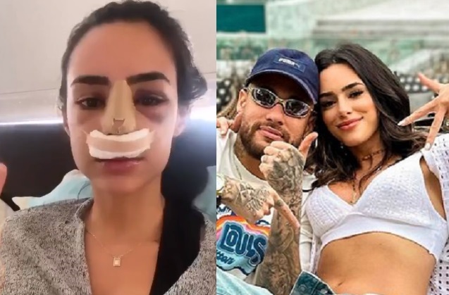 Vídeo de rinoplastia de Bruna Biancardi viraliza na internet; veja como era