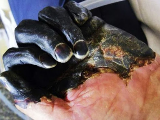 Primeira pandemia, Peste Bubônica pode ter matado um terço da população