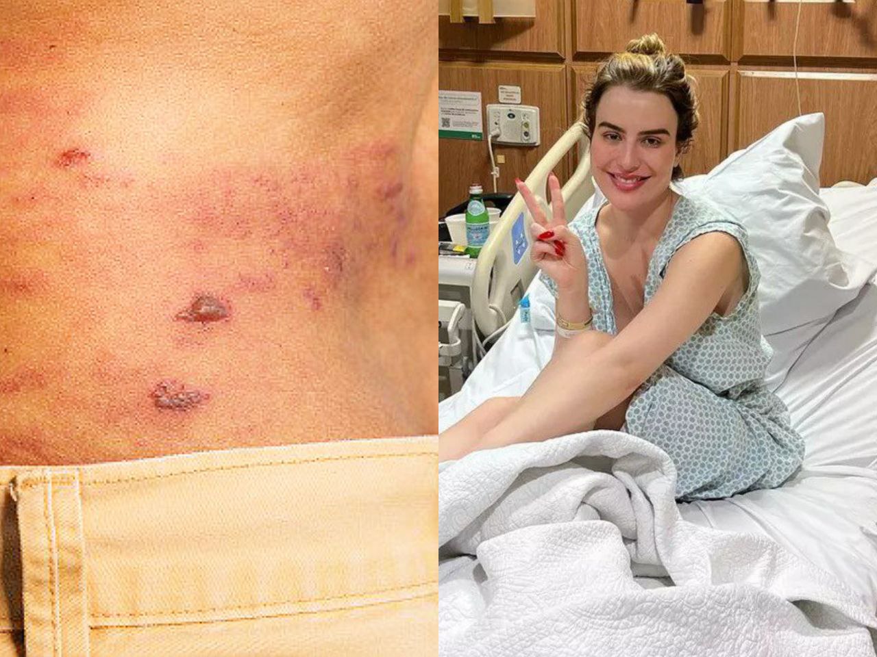 Saiba tudo sobre Herpes-zóster, doença diagnosticada em Fernanda Keulla