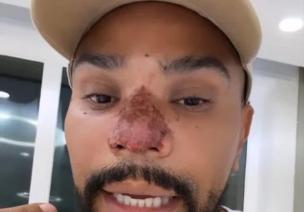 Naldo sofre princípio de necrose no nariz após rinomodelação
