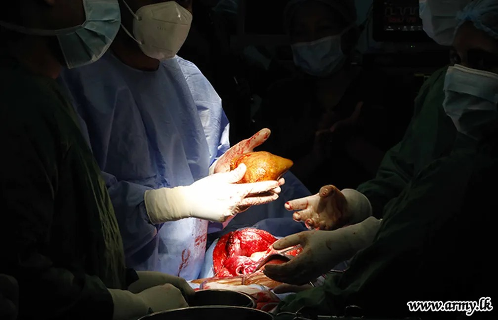 Diagnosticado com maior pedra no rim do mundo, soldado é operado; saiba o peso