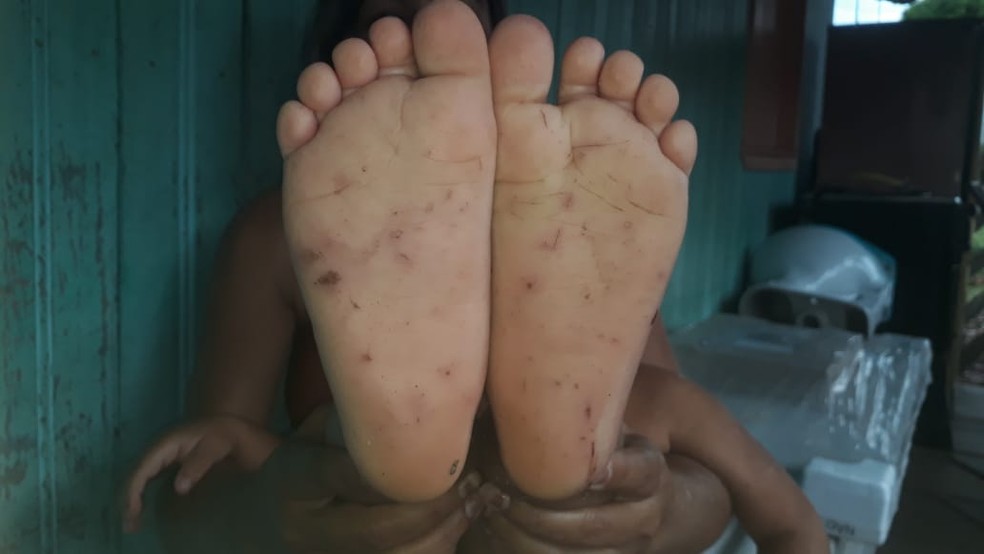 Criança de 3 anos apanha do pai com cipó e tem pés furados com espinhos