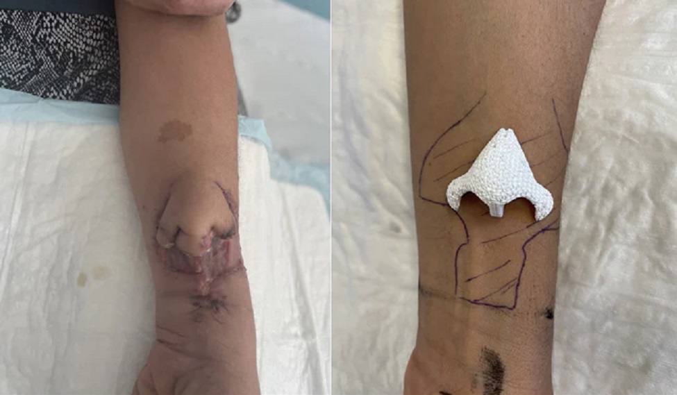 Nariz cresce em antebraço de mulher para transplante após câncer