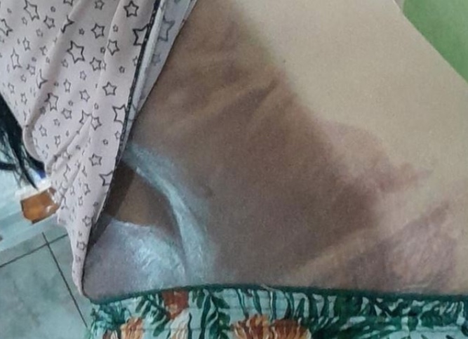 Suspeito de jogar água quente na esposa em Manaus é preso e diz que foi um 'acidente'