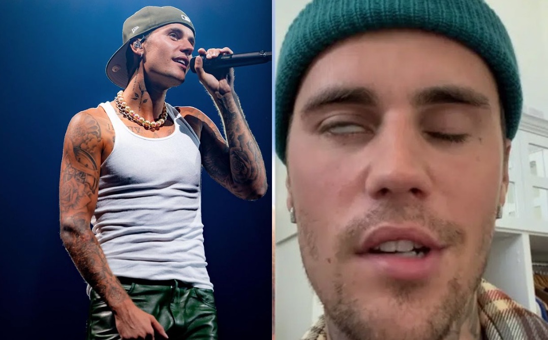 Com metade do rosto paralisado, Justin Bieber revela síndrome rara e pede orações