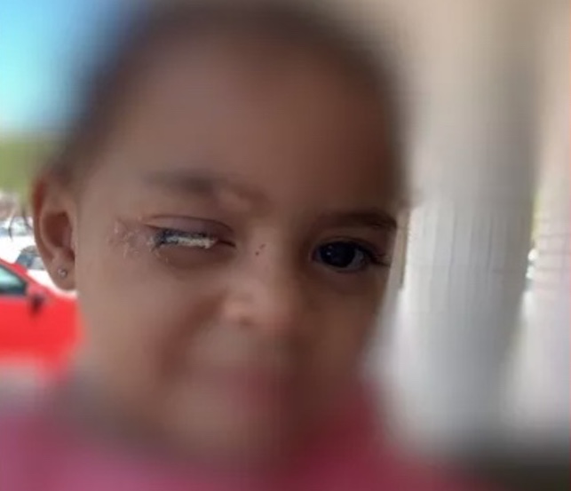 Criança de 2 anos passa cola no olho e família não consegue atendimento para remoção