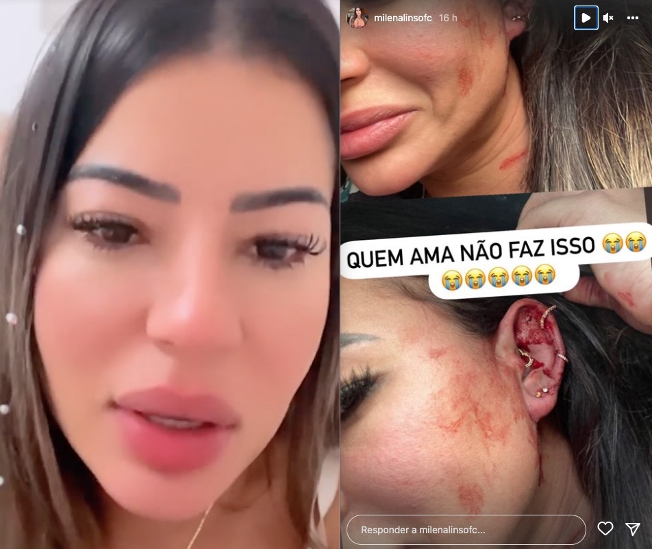 Influencer Milena Lins mostra rosto ensanguentado e acusa ex-namorado de agressão