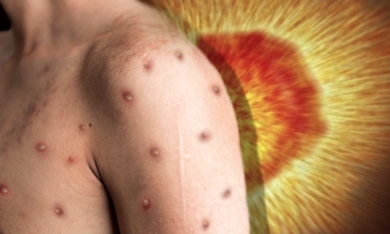 Com 37 confirmados, Amazonas investiga 20 casos suspeitos de varíola dos macacos