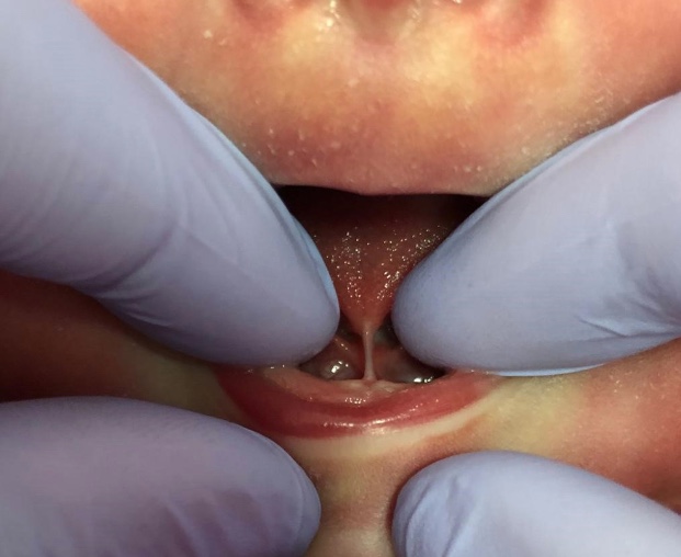 SES-AM assina acordo para realização de cirurgias de correção de freio lingual em bebês 