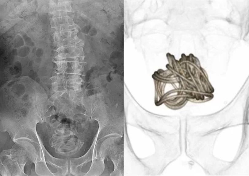 Homem enfia corda de 2,3 metros no pênis e objeto vai parar na bexiga