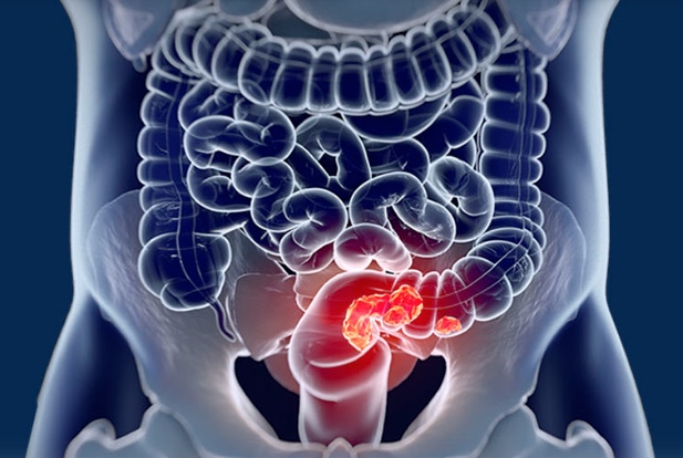 Lei que cria o ‘Março Azul Marinho’, de atenção ao câncer de intestino, é sancionada no Amazonas