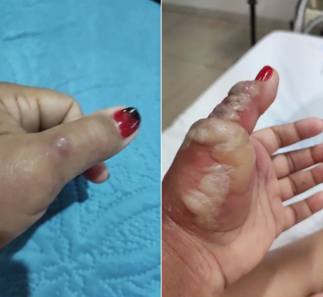 Mulher fica com tendão exposto após ser picada por aranha-marrom