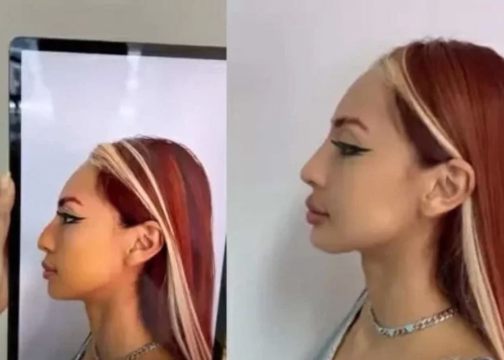 Ruivinha de Marte faz harmonização facial com rinomodelação e mostra antes e depois; foto