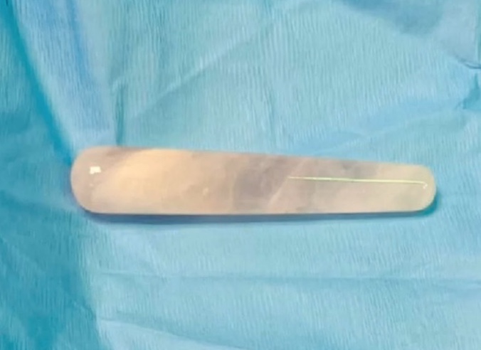 Mulher passa por cirurgia para retirar vibrador após ir parar em local errado