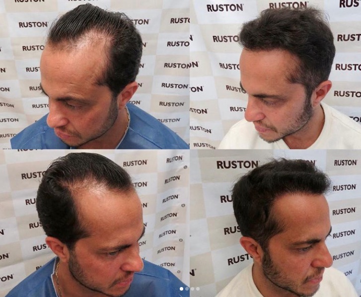 Thammy Miranda mostra resultado de transplante capilar: 'cabeludo de novo'