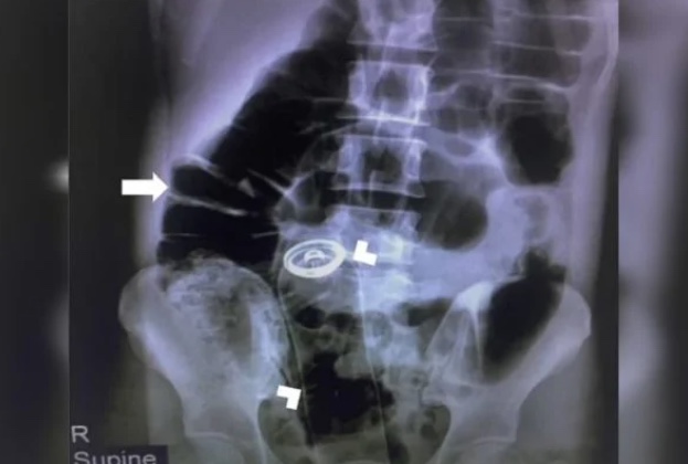 Homem passa por cirurgia após desodorante ‘sumir’ em ânus durante masturbação