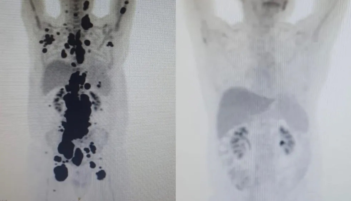 Homem com câncer há 13 anos tem remissão completa em um mês após terapia celular