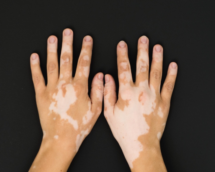 Amazonas emite alerta para alto número de casos de vitiligo no estado 