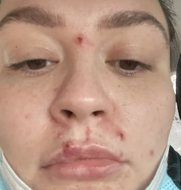 Mulher relata sobre doença após 'pelo inflamado na axila': "carne podre caía do meu corpo"