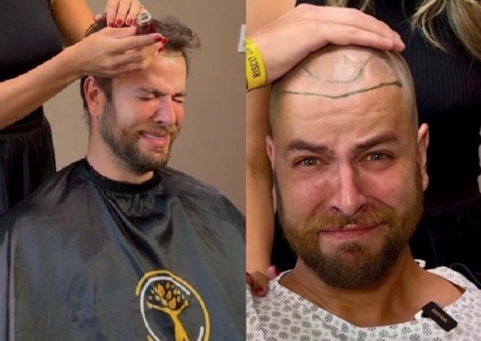 Veja o antes e depois do ex-BBB Gustavo Marsengo após transplante capilar 