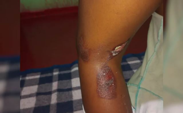Mãe é suspeita de queimar filha porque criança estaria 'comendo demais'