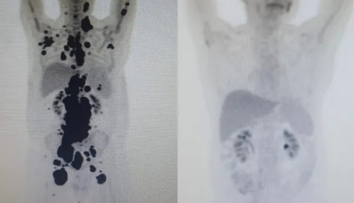 Novo exame aponta que paciente que tratou câncer com terapia continua em remissão