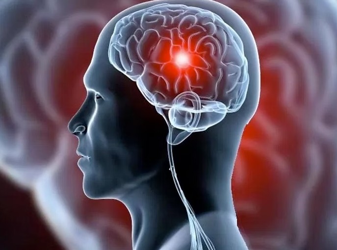 AVC mata uma pessoa a cada seis minutos no Brasil