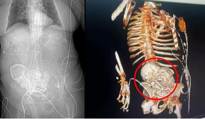 Médicos descobrem “bebê de pedra” calcificado no abdômen de idosa há 56 anos