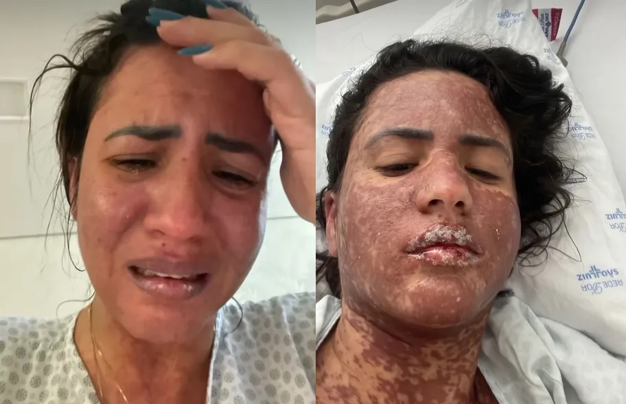 Mulher de Frank Aguiar é internada na UTI com doença rara que queima a pele