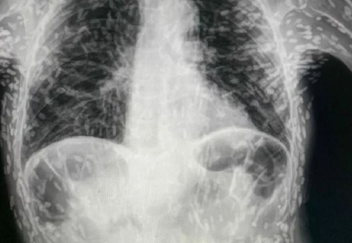 Raio-x de paciente com tosse persistente mostra tórax cheio de ovos de tênia