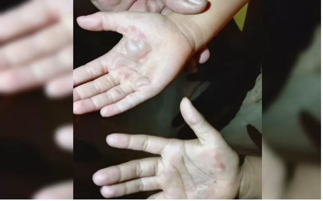 Mãe queima mãos de filhas como castigo por comerem caixa de leite condensado