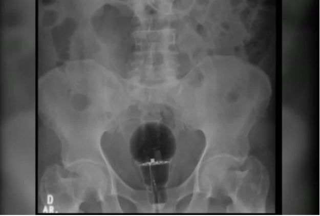 Com lâmpada no ânus, homem passa dias sentindo dores por medo da esposa