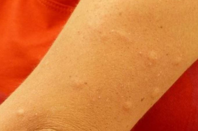 Especialistas dão dicas para ceia de quem tem alergias alimentares