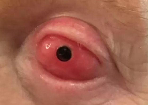 Técnica rara usa dente para restaurar visão de homem cego há 20 anos