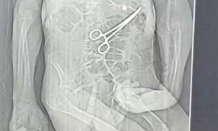 Idoso morre após ter pinça esquecida no corpo após cirurgia em Minas Gerais