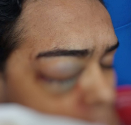 Jovem leva tiro de pressão durante arraial em shopping e fica com bala alojada no olho em Manaus