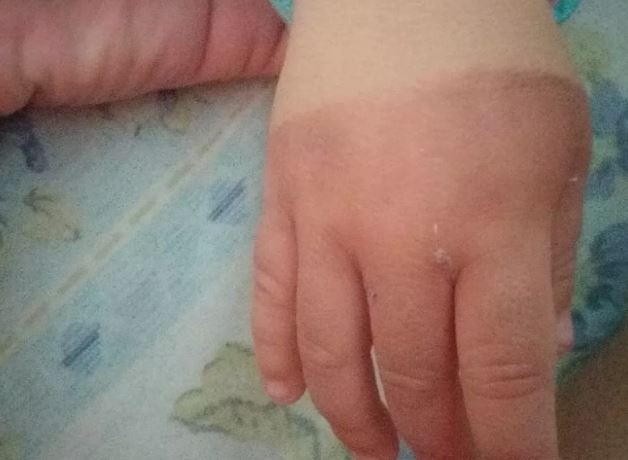Babá é suspeita de queimar com água quente mão de bebê de 1 ano