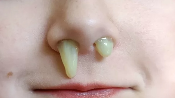 Saiba o que indica a cor do catarro sobre a saúde; verde e amarelo são os mais comuns