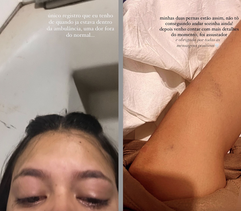 Cantora Brisa Star posta foto com perna machucada após acidente