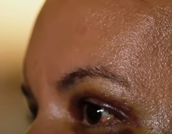 Mulher que teve rosto desfigurado com 61 socos manda recado para agressor: 'Sobrevivi'