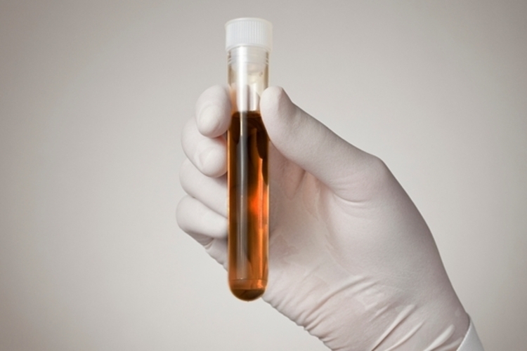 Amazonas tem 119 casos confirmados de rabdomiólise