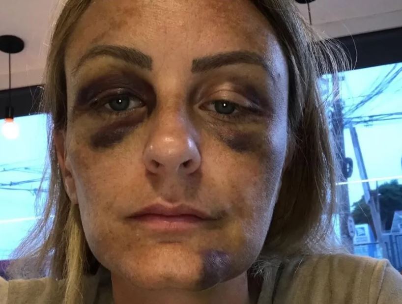 Ex de brasileiro que agrediu surfista americana revela que também foi espancada por ele